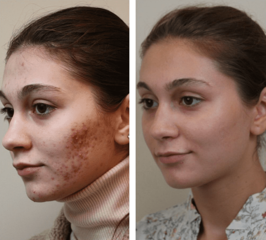 Вот так выглядит акне на лице девушки до лечения и после.